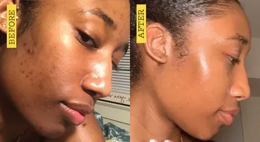 A before and after photo of a woman 's face