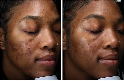 A before and after photo of a woman 's face with acne
