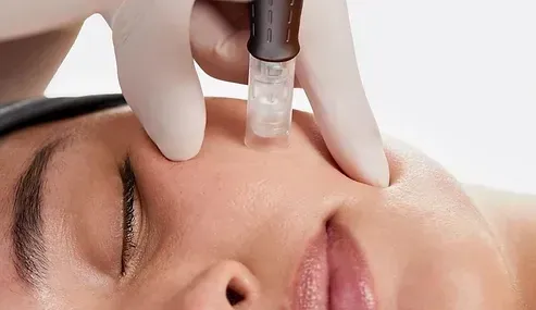 A woman is getting a microdermabrasion treatment on her face