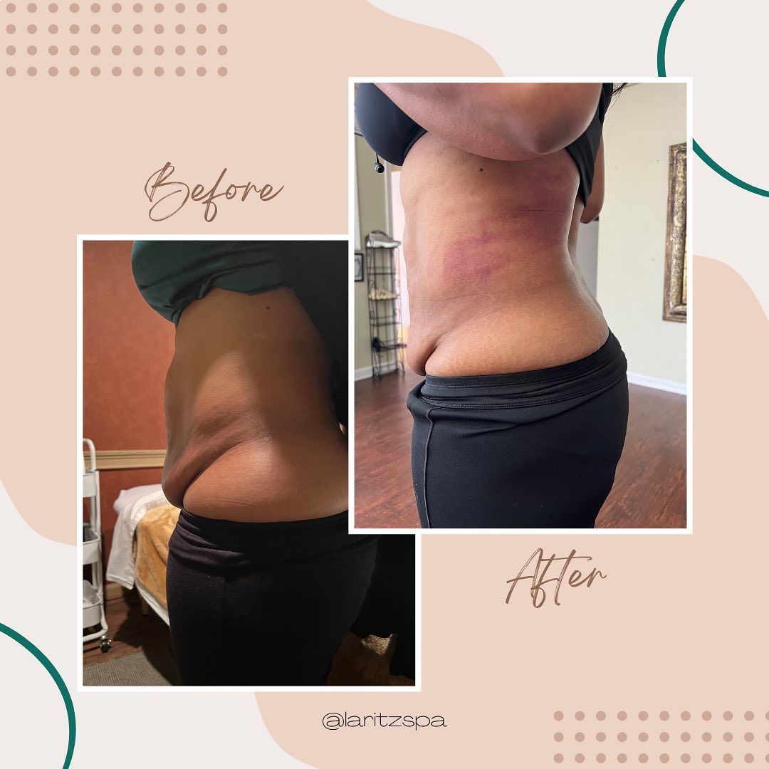 A before and after photo of a woman 's stomach