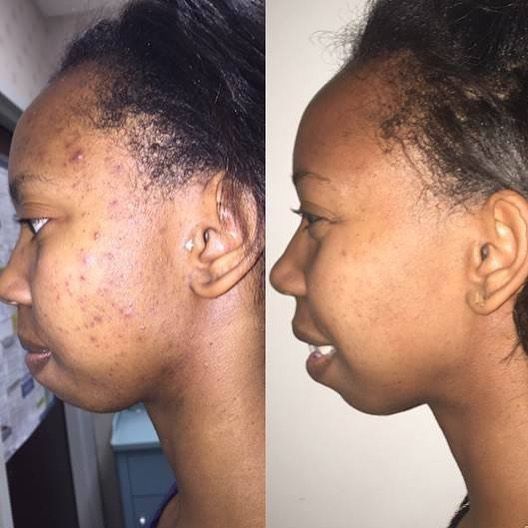 A before and after photo of a woman 's face.