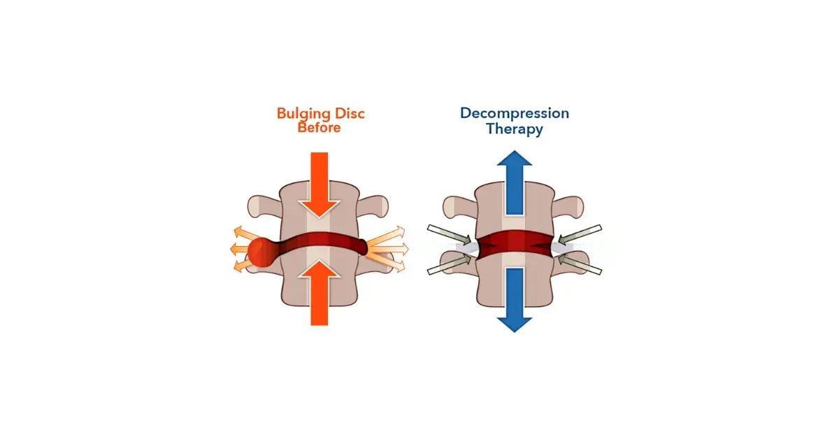 A diagram showing the difference between a bulging disc and a compression therapy.