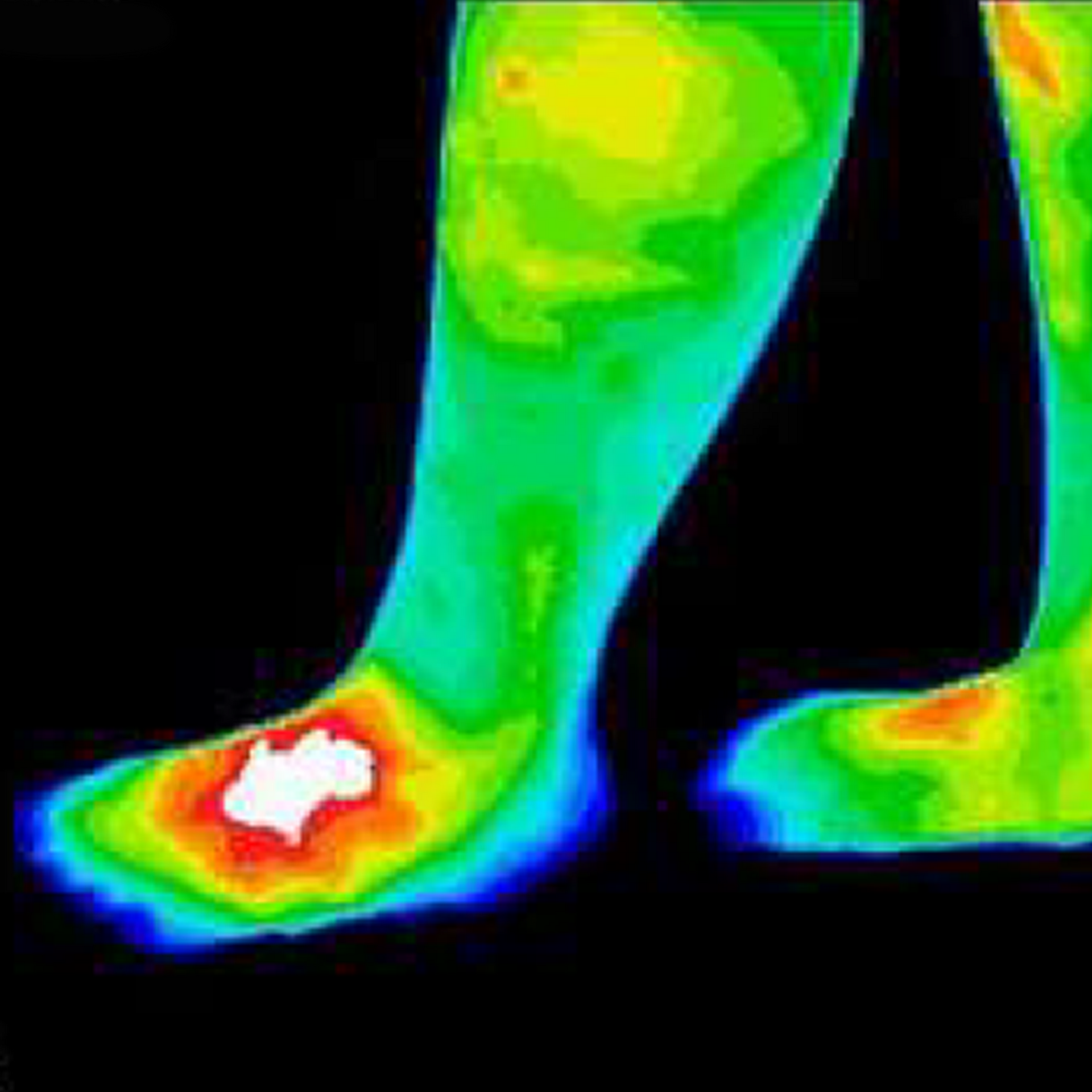 Thermal imaging of a foot