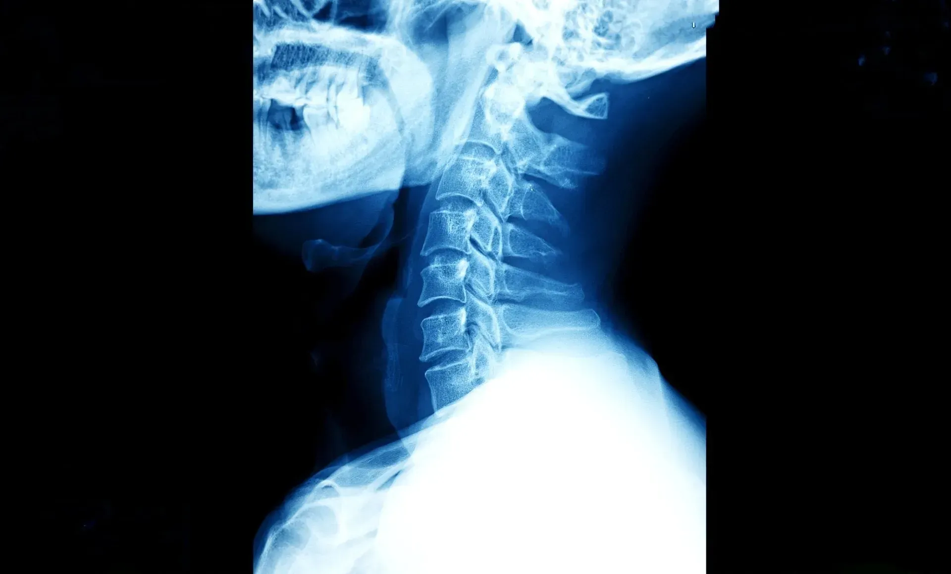 A close up of an x-ray of a person 's neck.