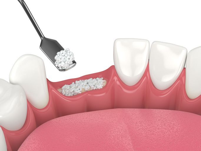 Dental floss being applied between teeth to remove plaque from pink gums.