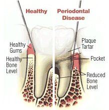 healthy gums vs periodontal disease gums