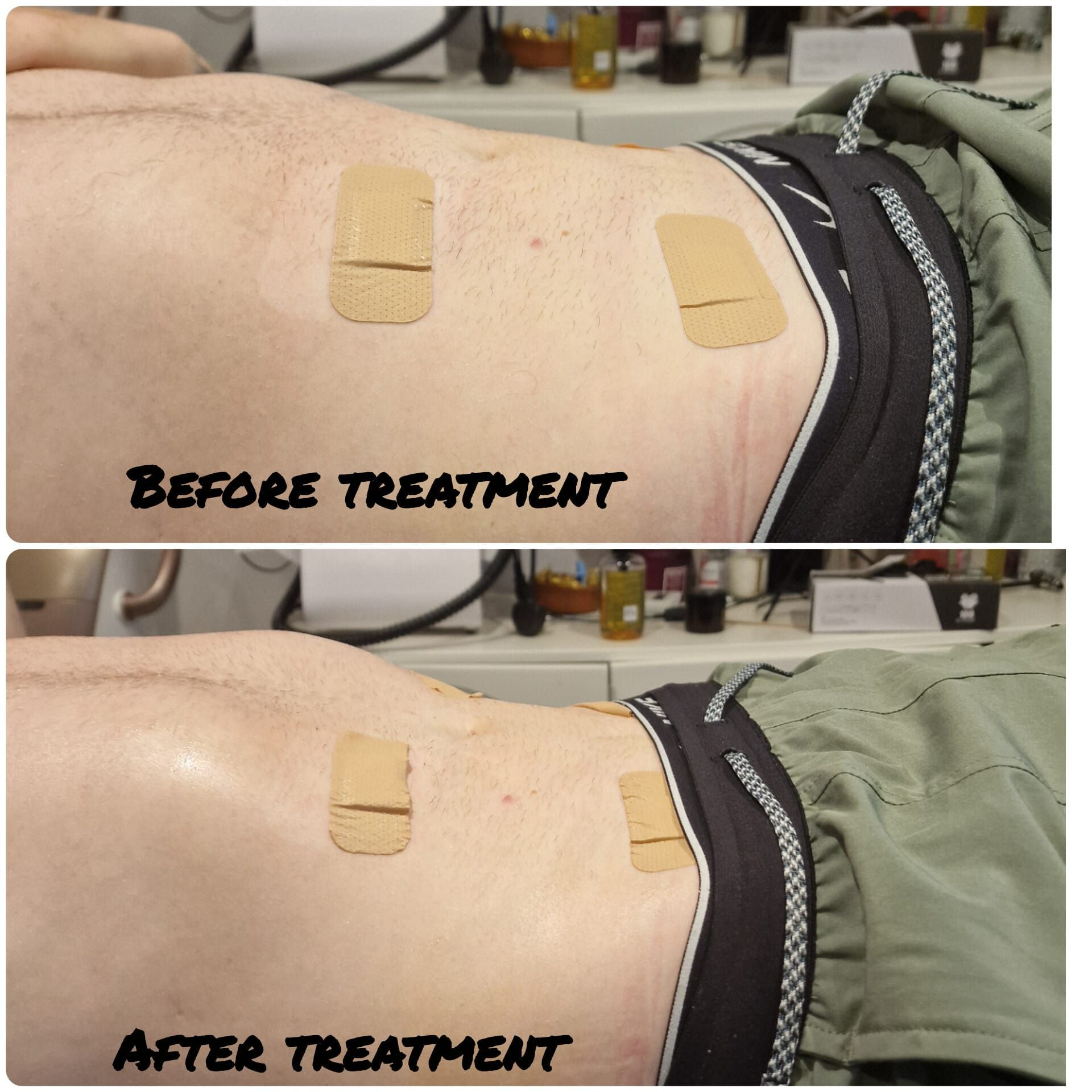 Post MLD treatment
Bodylanguage HB image