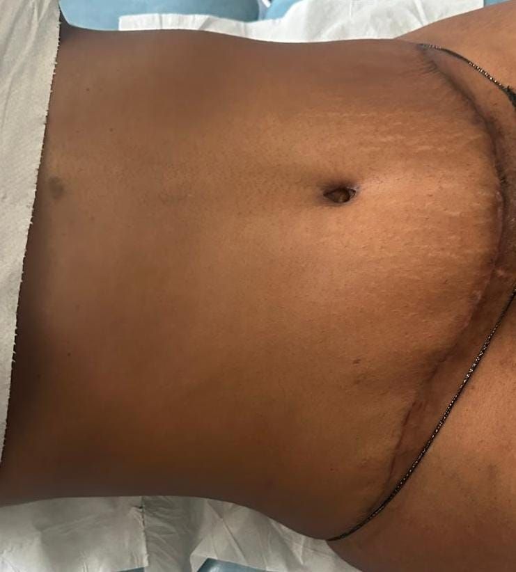 Ultrasonic cavitation and RF Frequency 