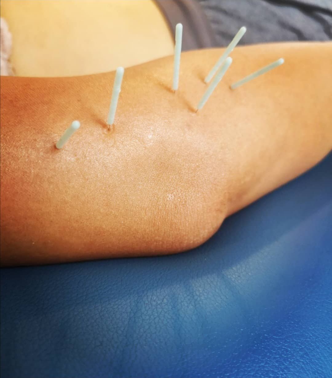 A person is getting acupuncture on their arm.