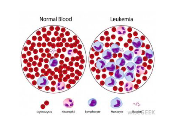 LEUKEMIJA