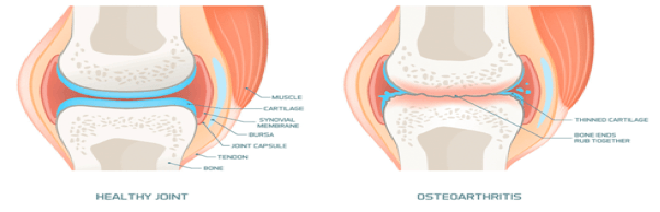 etiologija osteoartritis liječenja što uzrokuje bol u ramenskim zglobovima