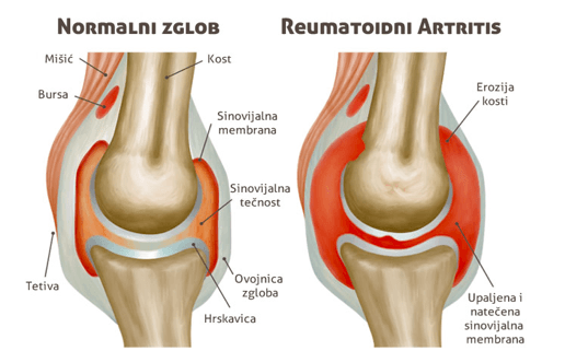 s artrozom liječenja zgloba kuka fizičke vježbe u liječenju artroze
