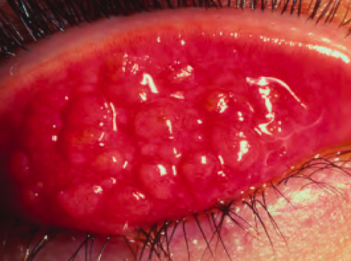 Konjunktivitis  Pink Eye (DRUGI DIO  Neinfektivni konjunktivitisi)