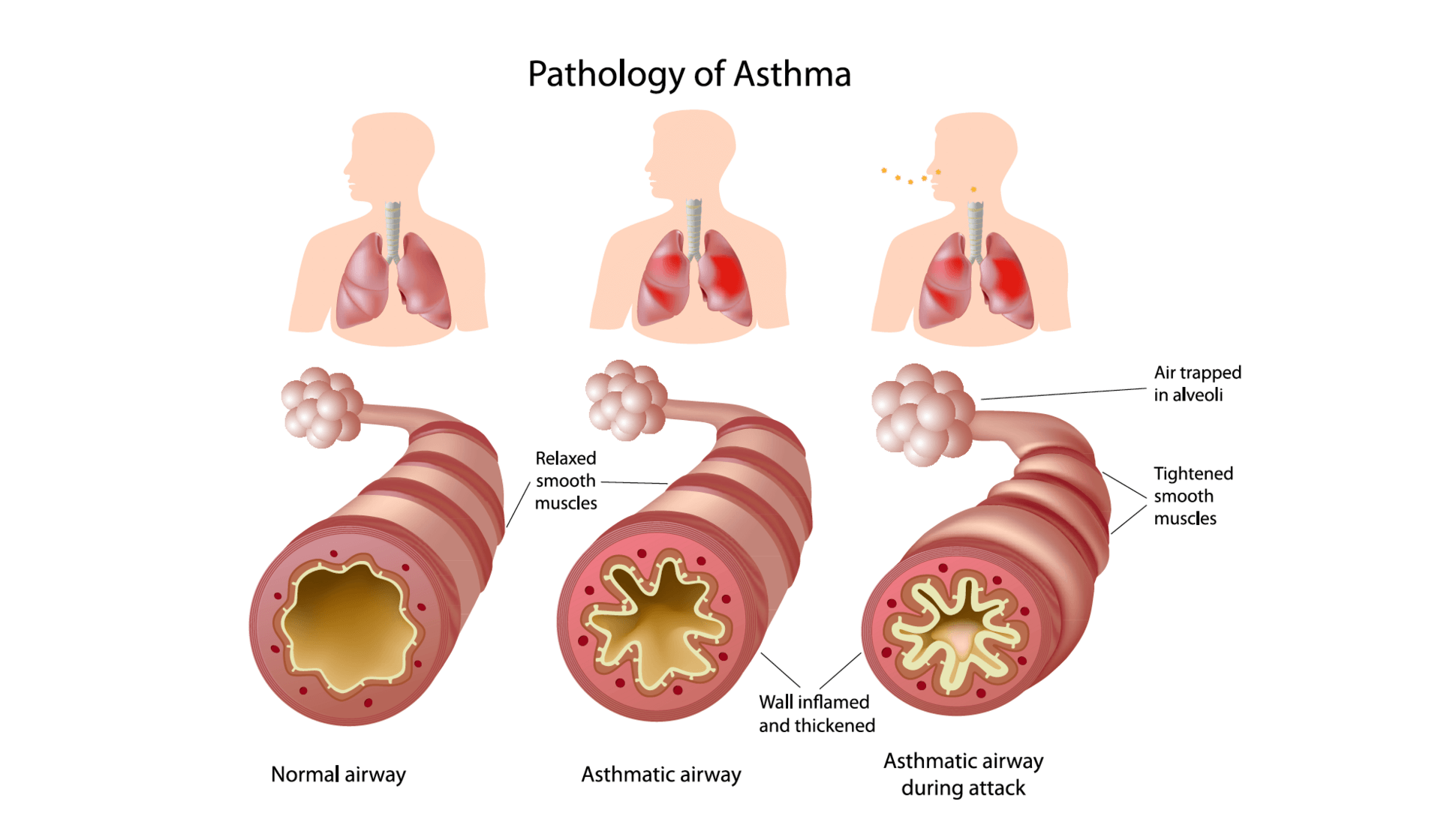 Бронхиальная астма локализация