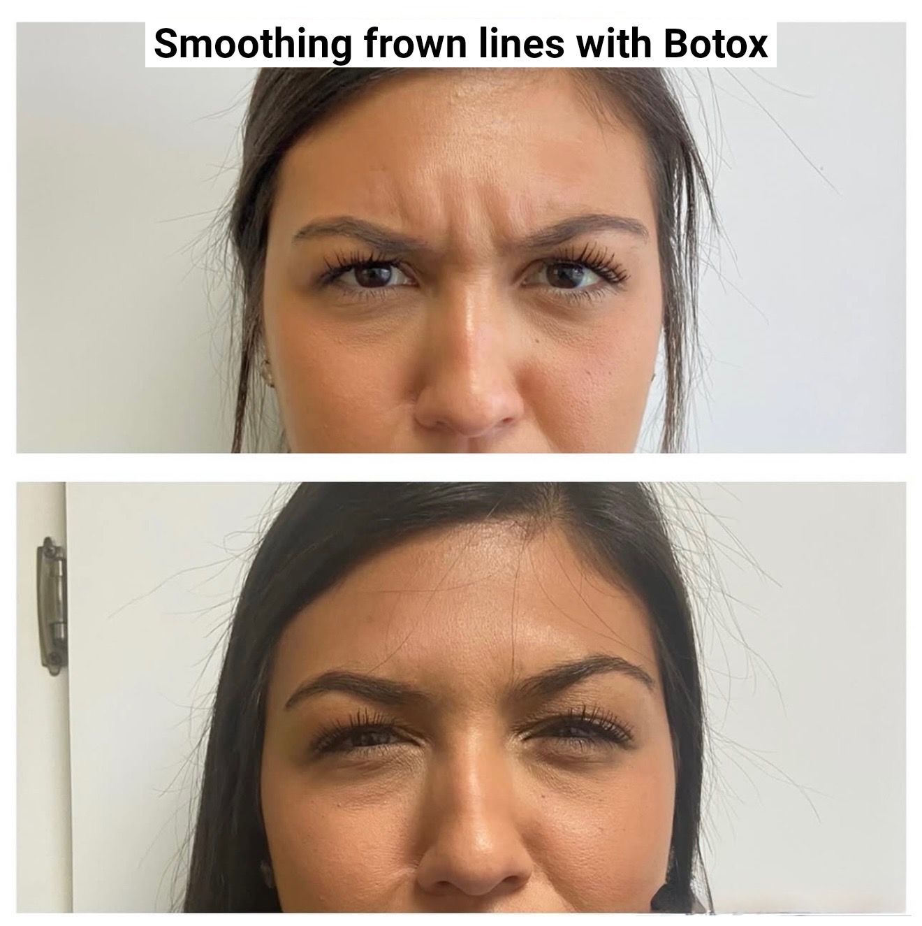 Before and after photos of a woman's frowning expression smoothed by a cosmetic procedure.