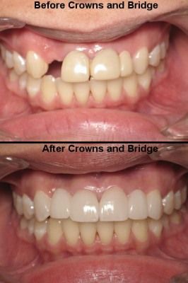 Before/after dental crowns and bridge: Top shows gap, bottom shows complete, white teeth.