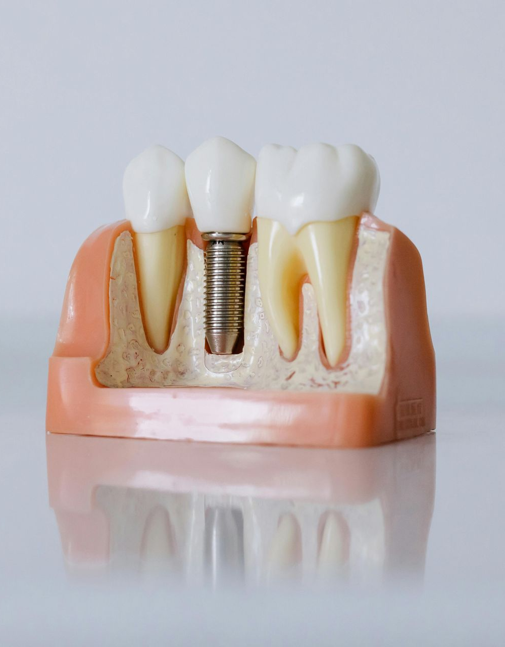 Model of a dental implant: a tooth-shaped crown on a metal post anchored in jawbone, flanked by healthy teeth.