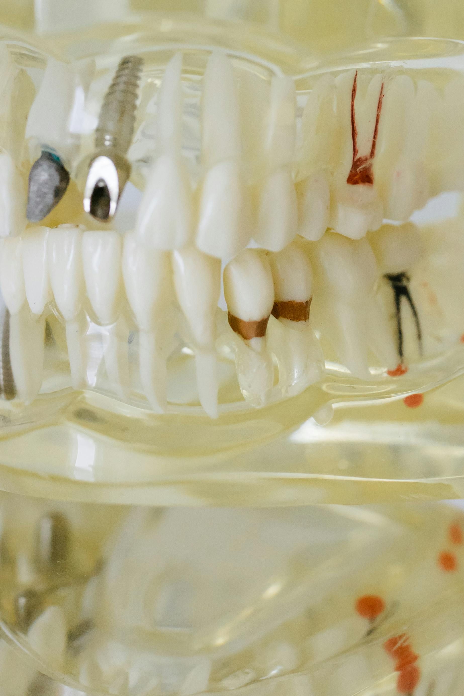 Close-up of a dental model showing teeth with various treatments, including a crown, implants, and root canals.