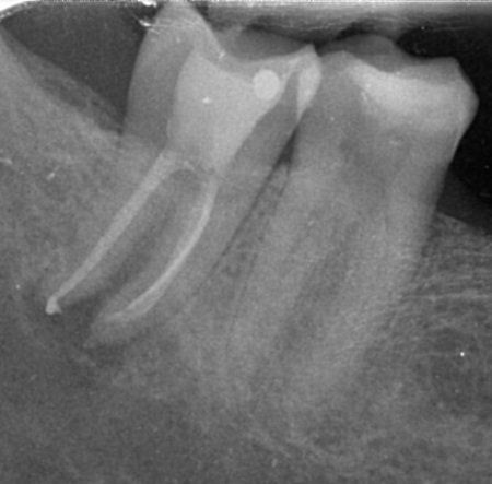 endodonzia