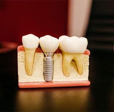 Implantes dentales