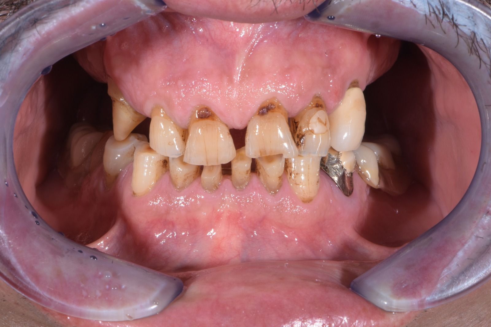 Trauma dentale