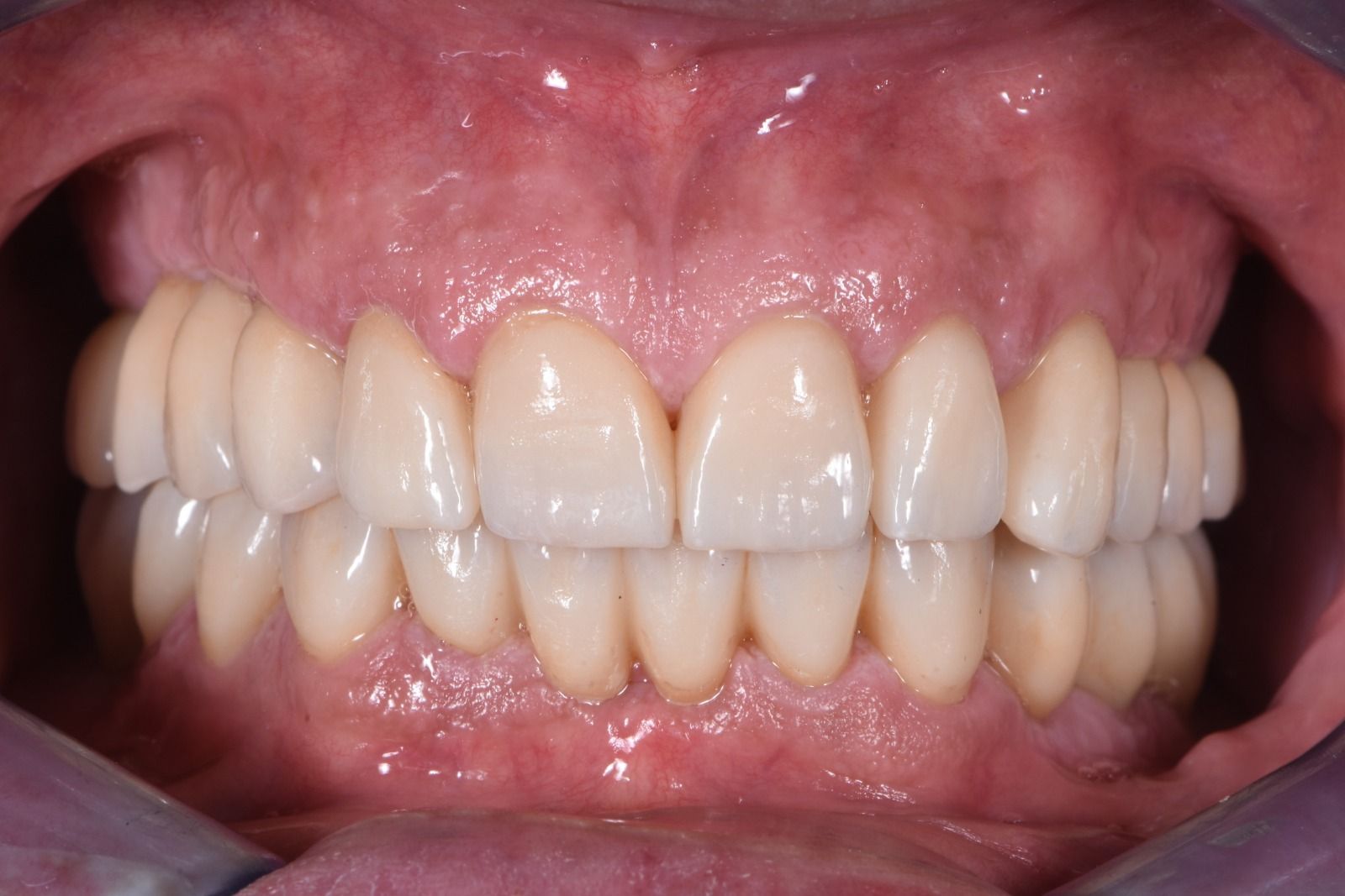 Riabilitazione con faccette in ceramica