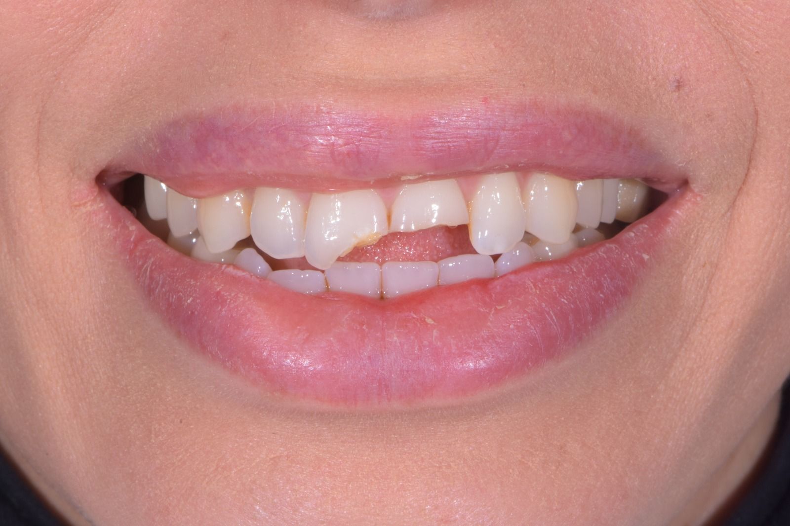 Trauma dentale