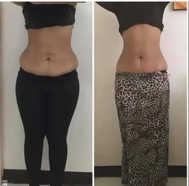 Before and after comparison of a woman's abdomen. Left side: wearing black; Right side: wearing leopard print skirt.