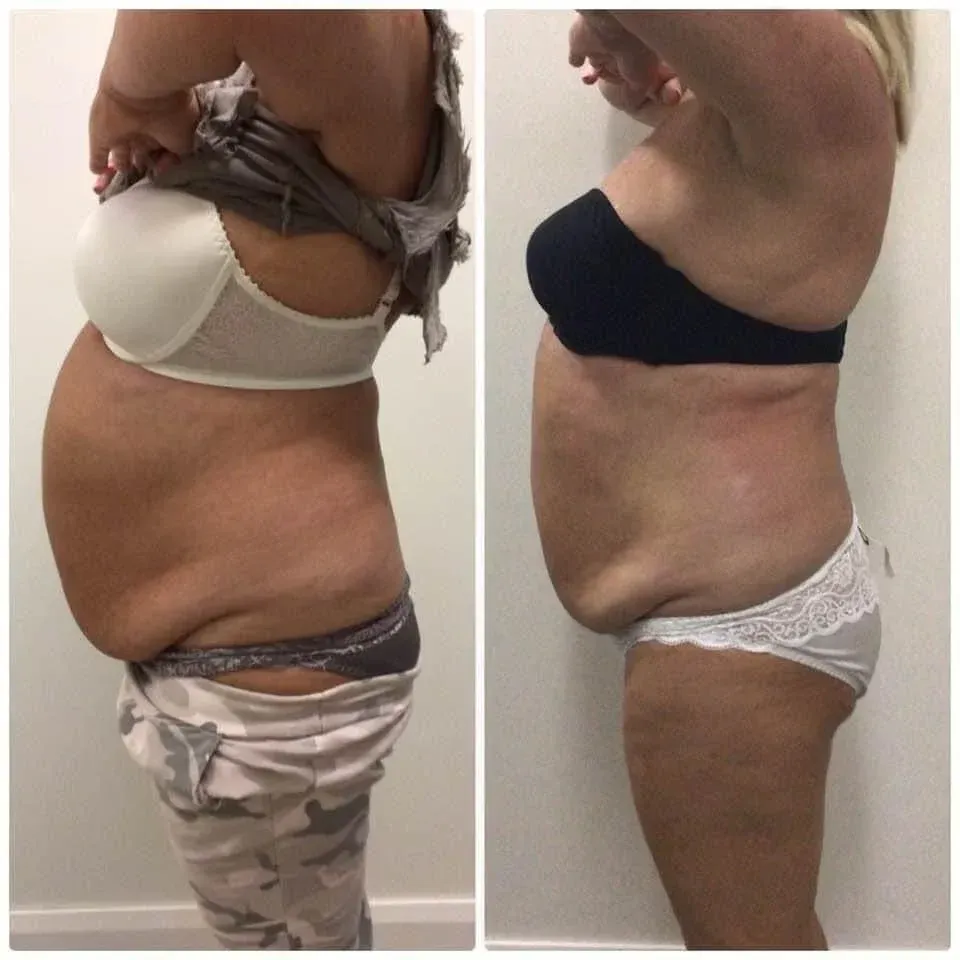 Side-by-side photos of a woman before and after a body transformation. She is wearing bras and underwear in both photos.