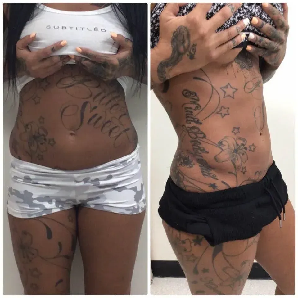 Before and after photos of a tattooed woman's torso, wearing shorts and a crop top.