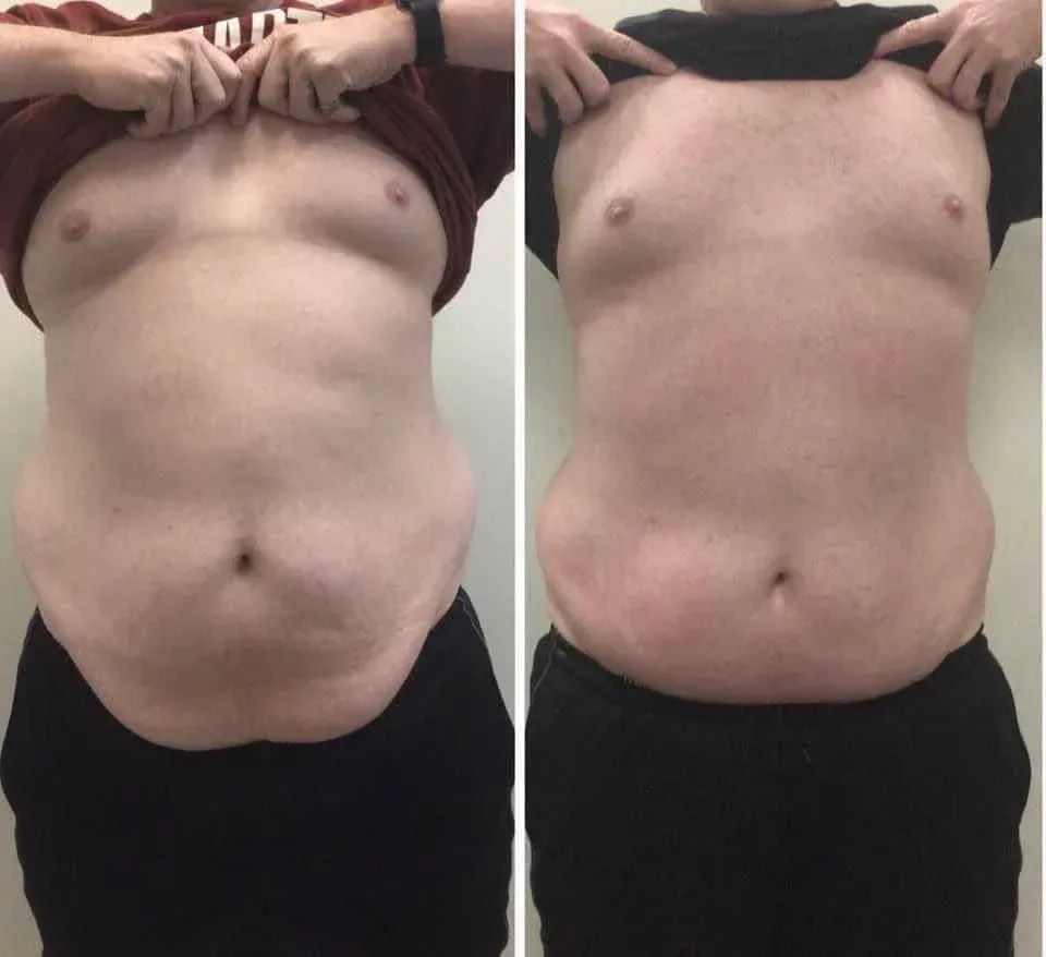 Before and after transformation. The skin tone appears unchanged, while the abdomen is visibly reduced.
