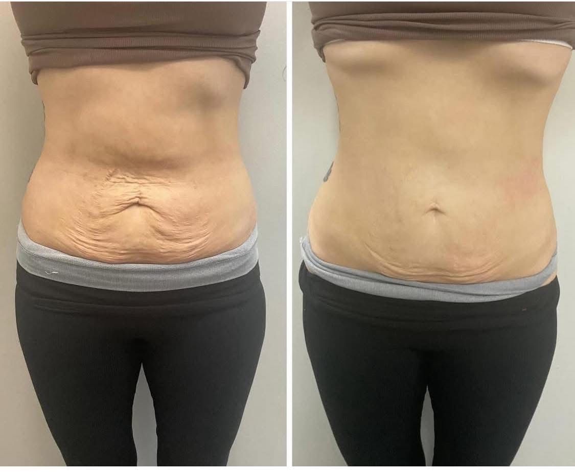 Before-and-after photos of a person's abdomen; skin appears tighter and less wrinkled on the right.