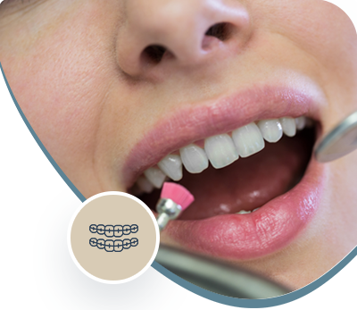 Close-up of teeth being polished with a dental tool during orthodontic cleaning.