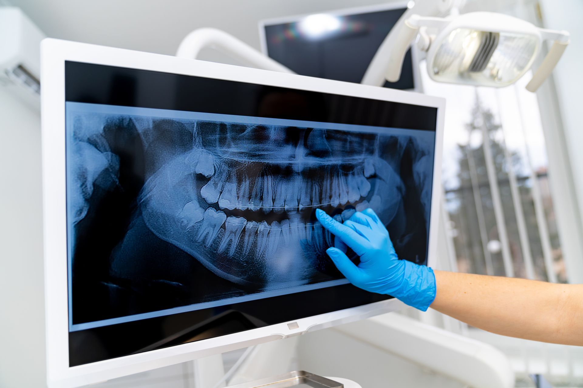 Dental X-ray on a monitor as a gloved hand points to a tooth in a bright clinic
