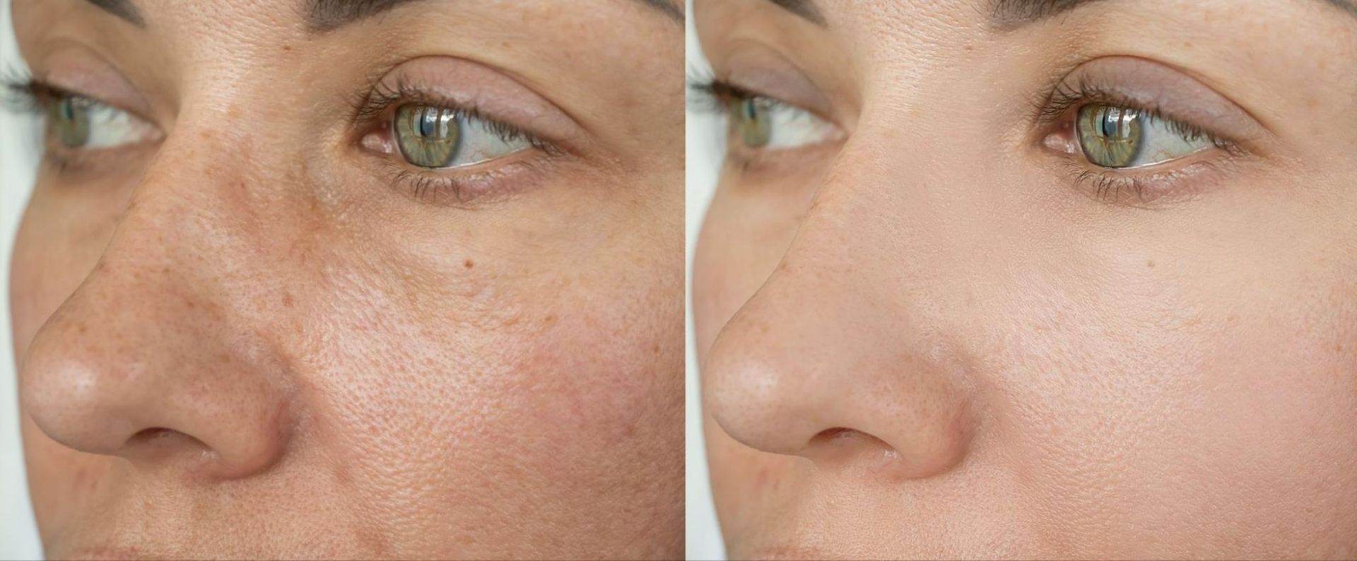 Facial volume loss before and after correction treatment