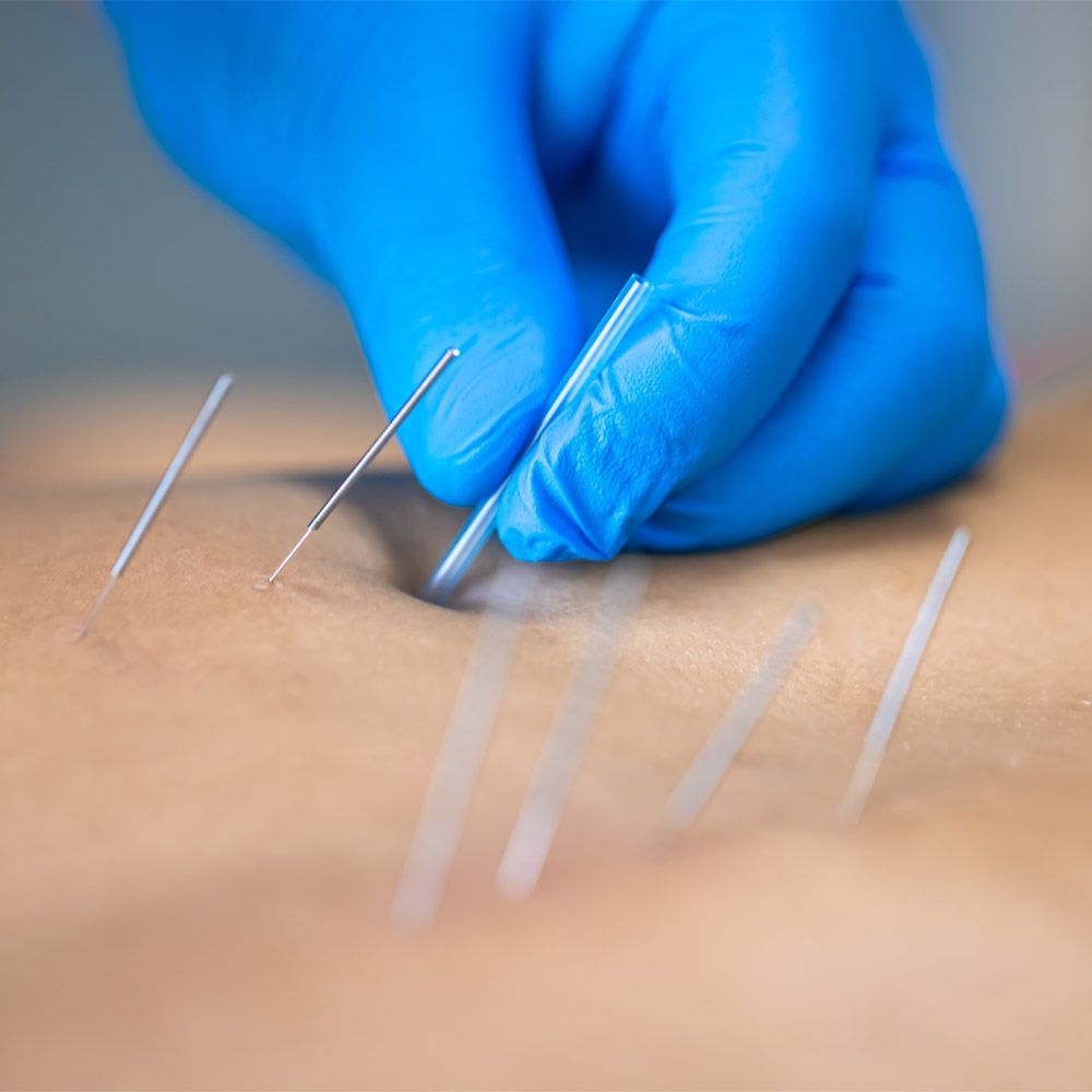 Une personne reçoit de l'acupuncture sur le ventre.