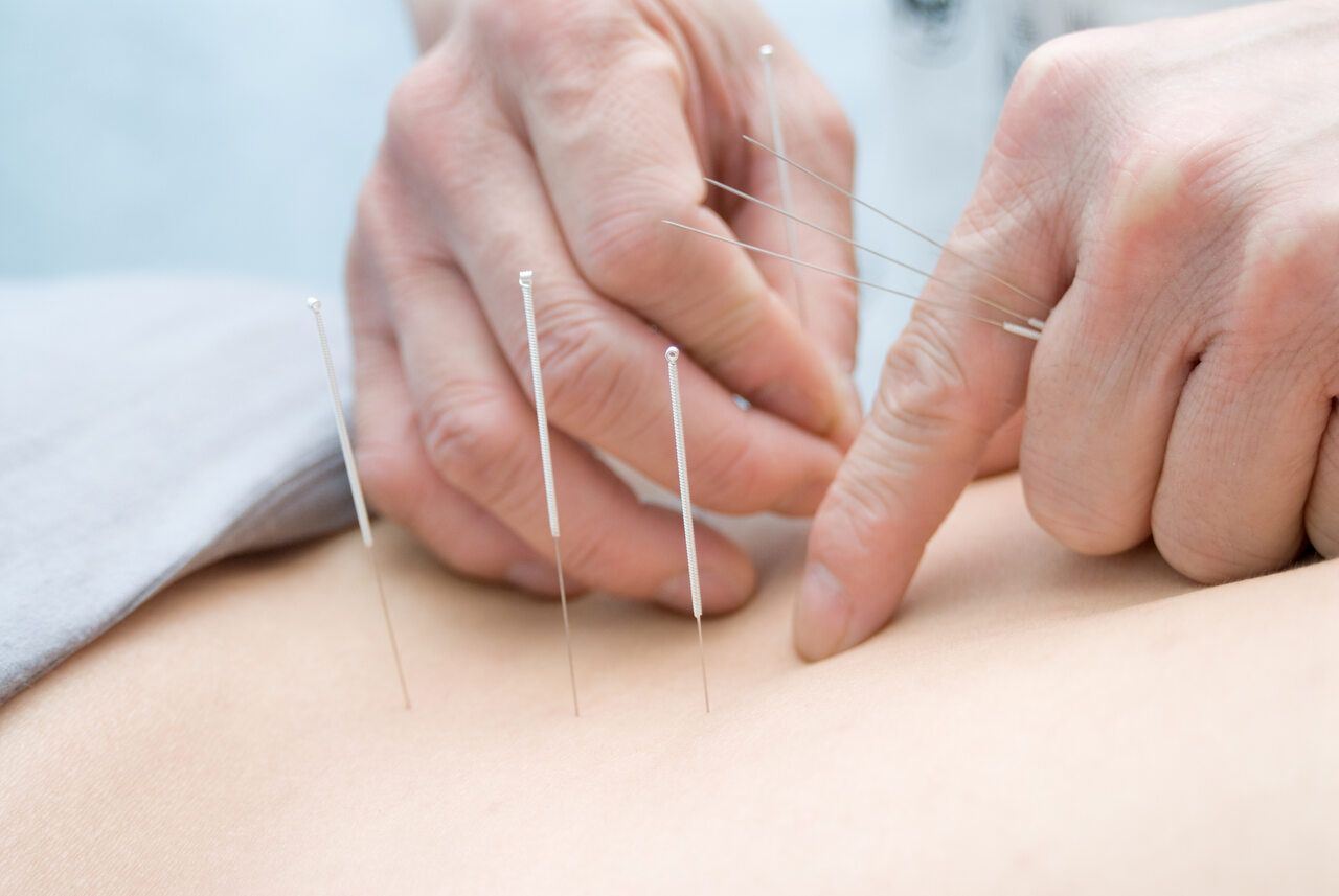 acupuncture for pinched nerve toronto downtown