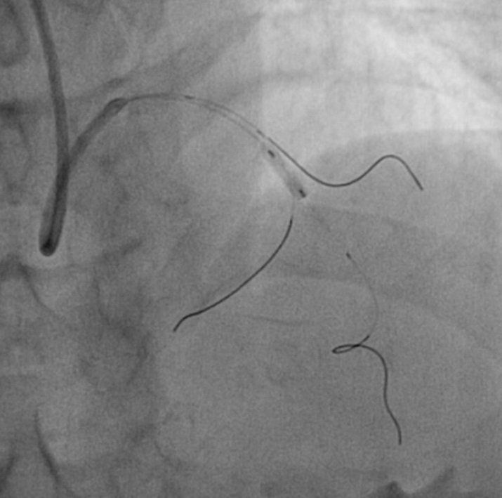 lastra di un intervento di cardiologia