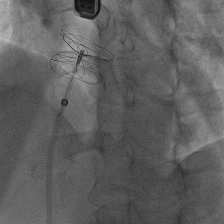 lastra di un'operazione di cardiologia