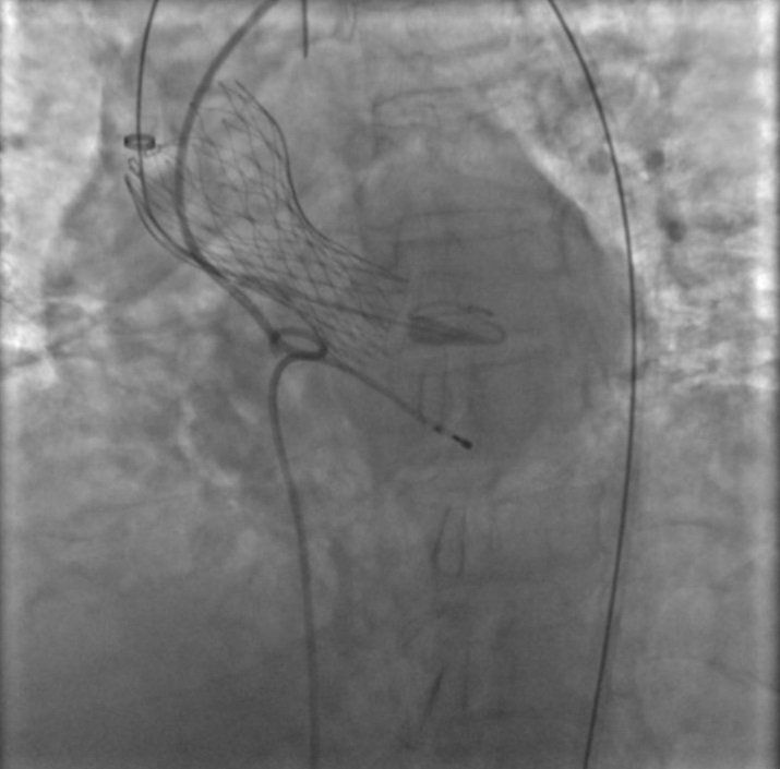 lastra di un intervento strutturale di cardiologia