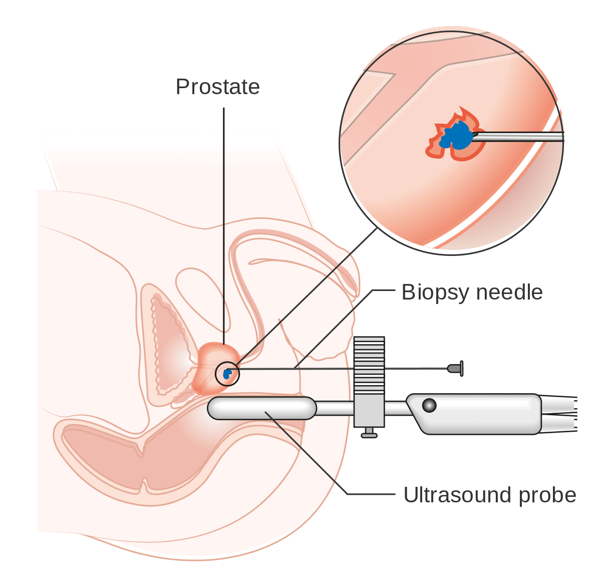 transperineal, biopsy, prostate