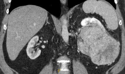large renal mass, kidney tumour, kidney cancer, advanced tumour, CT scan, T2/3 tumour, computed tomography