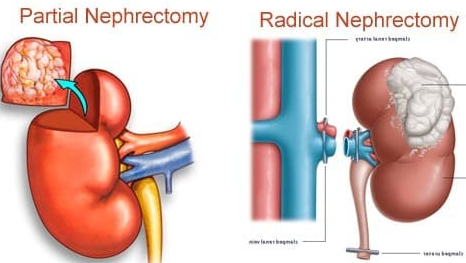 Partial nephrectomy, Radical nephrectomy