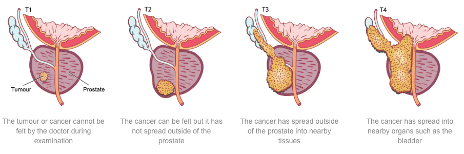 T staging, prostate cancer