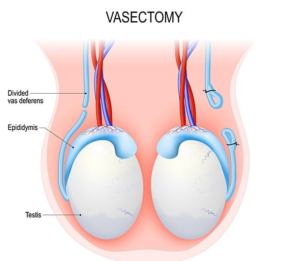 Birth Control Methods: Vasectomy Breaktrough