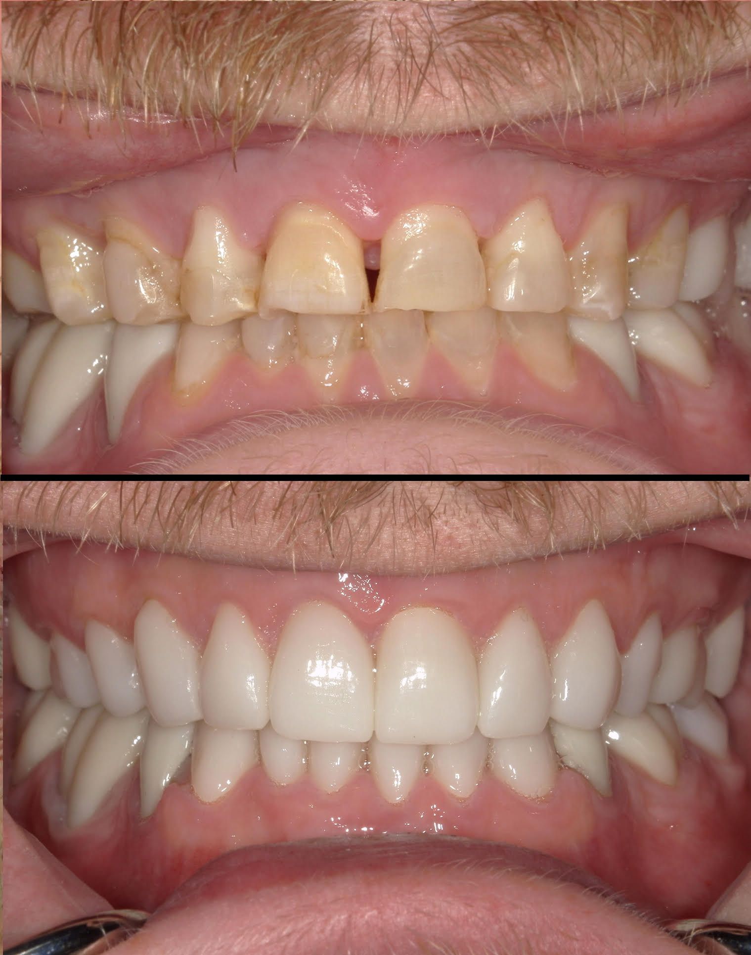 Top: Yellowed teeth with a gap. Bottom: Whitened teeth, aligned, and without gaps.