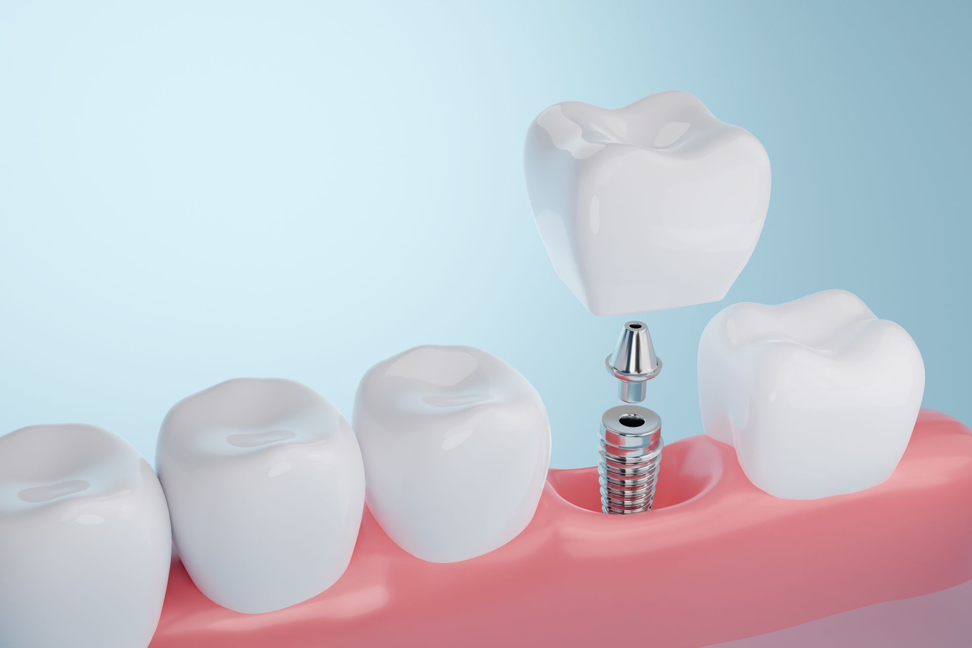 Dental implant model showing crown being placed on screw anchored in jawbone.