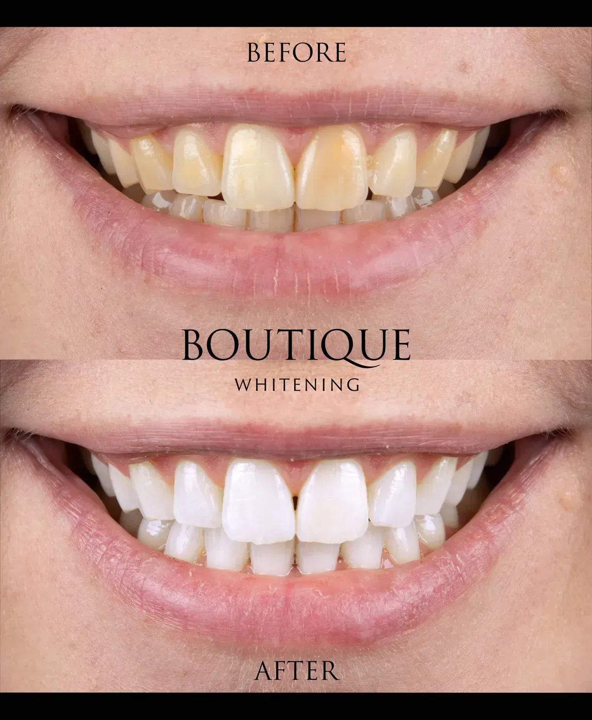 A Before and After Photo of a Woman's Teeth — Jaw Gear Dental Prosthetics in Bowral, NSW