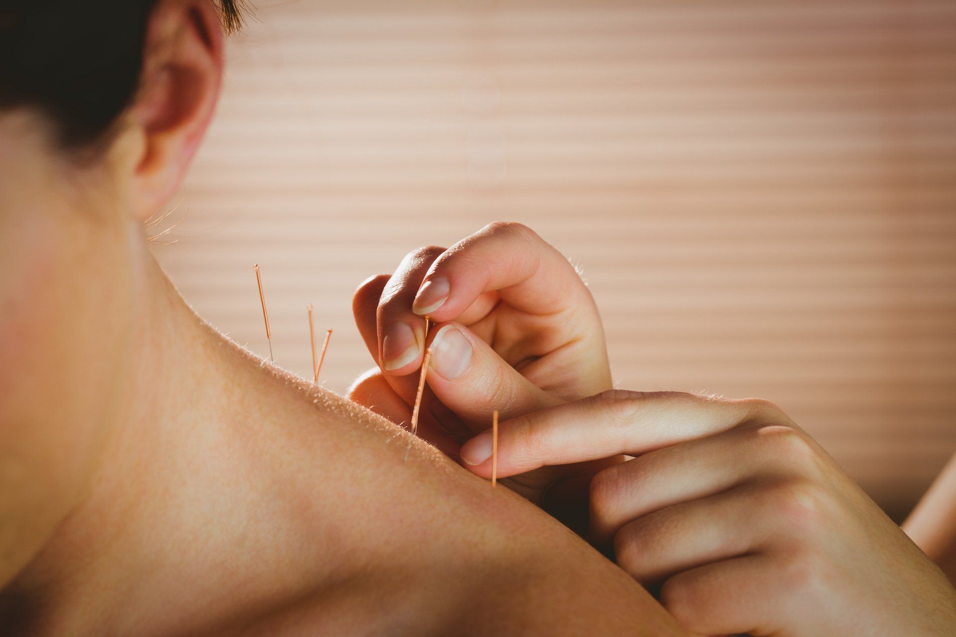 picture of a man receiving dry needling procedure in his shoulder area
