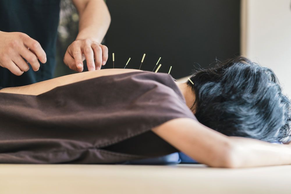 Acupuncture, an ancient healing practice with roots in traditional Chinese medicine.